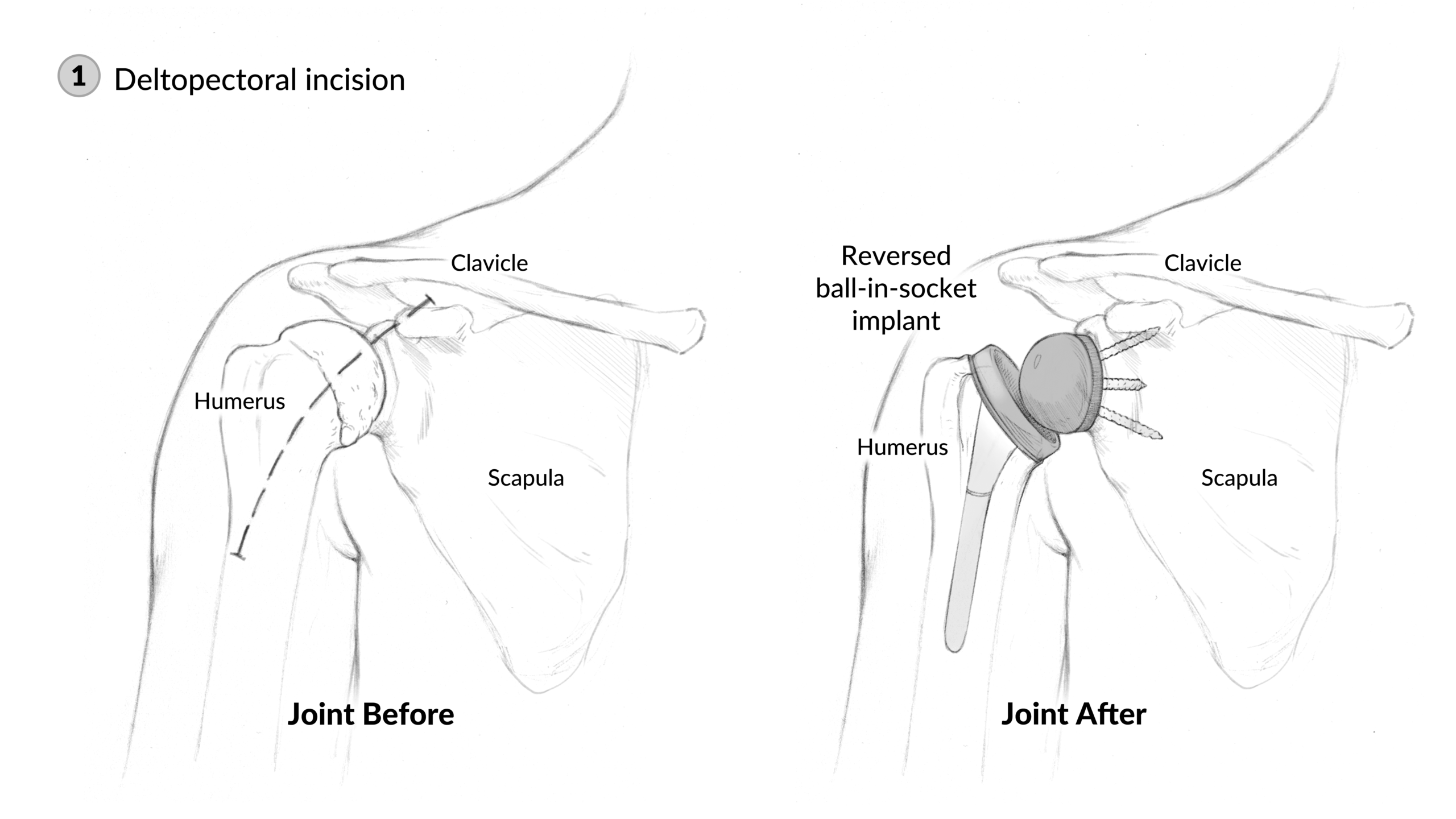 1_DP Incision