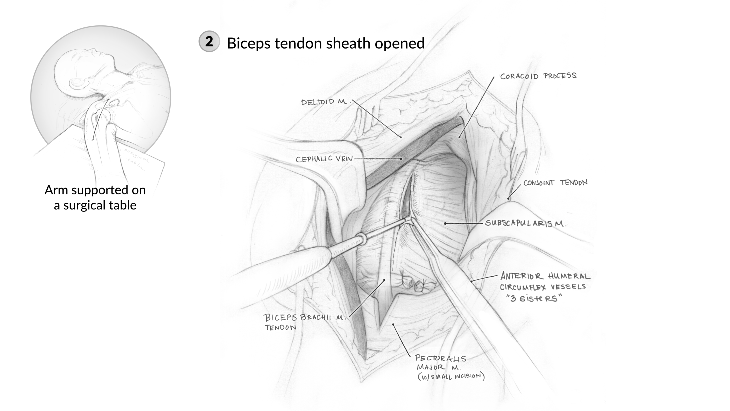 2_Tendon Release2