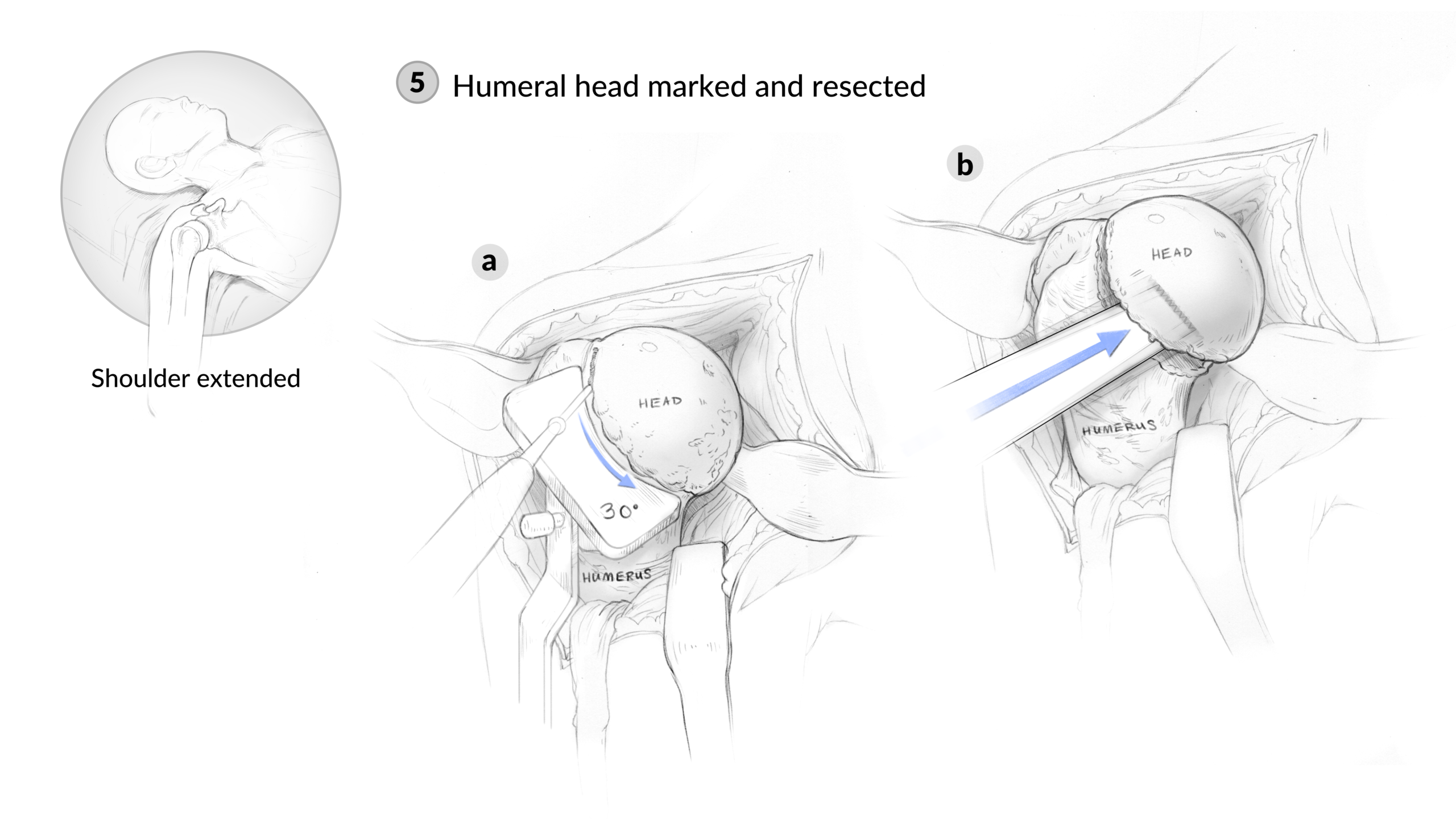 4_Humeral Head Resection