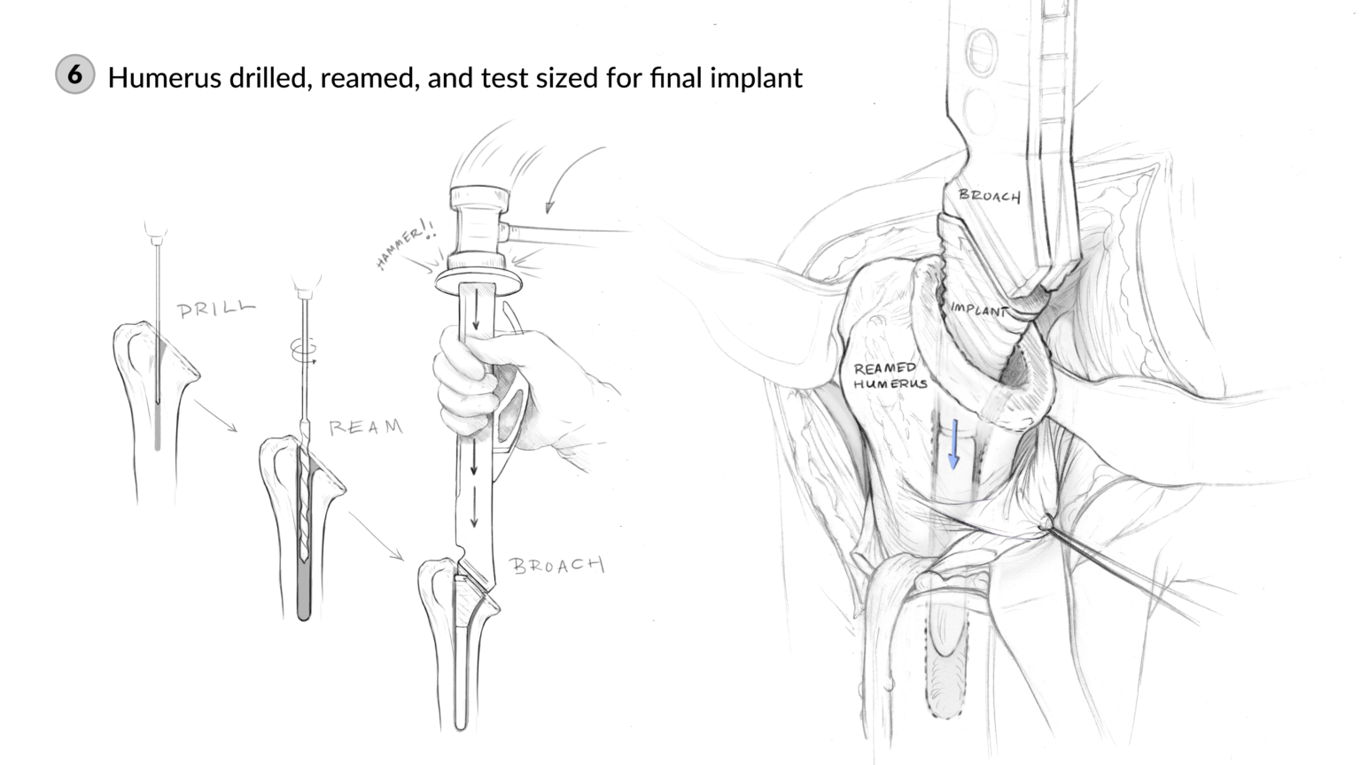 5_Humerus Implant