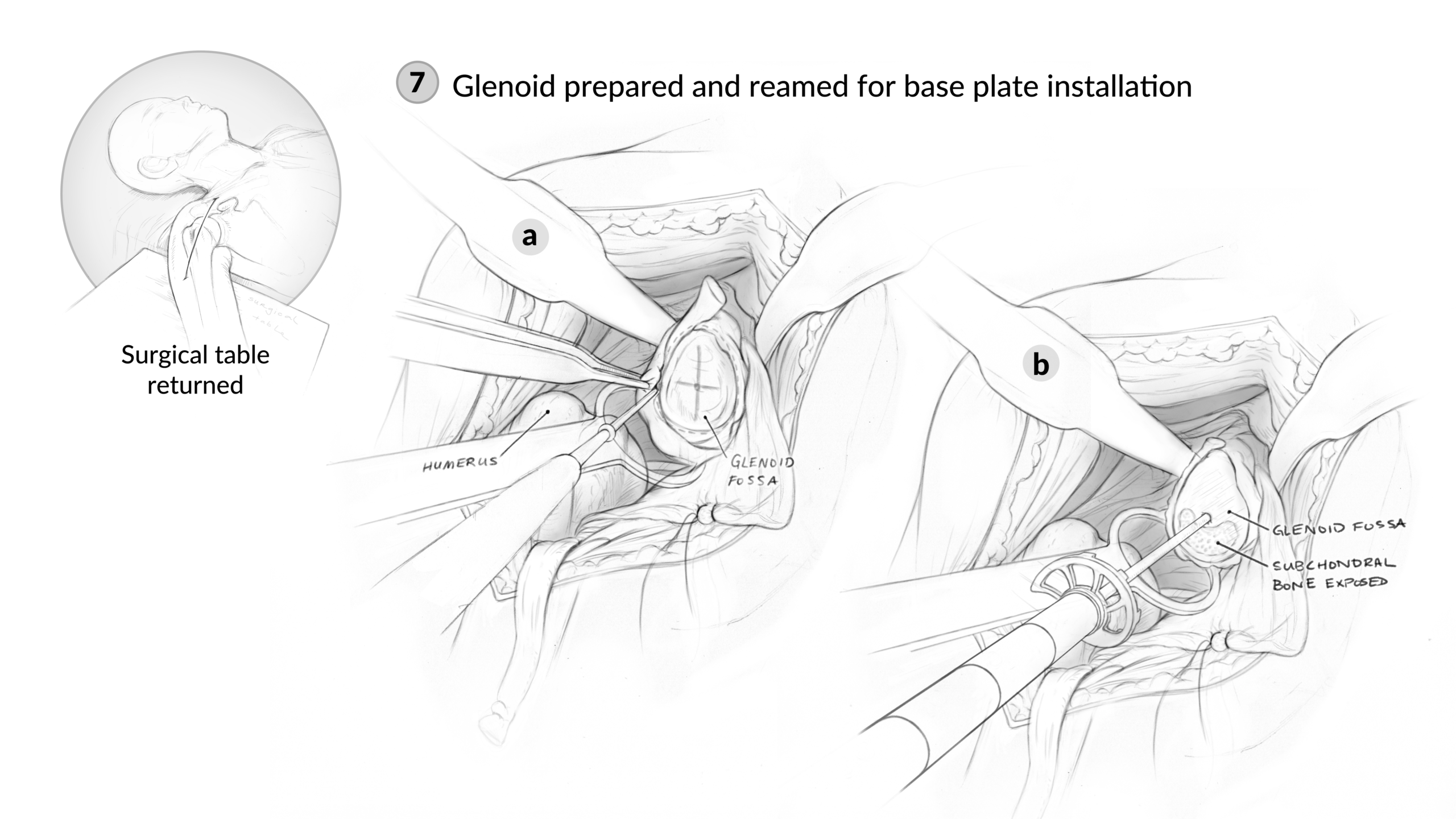 6_Glenoid