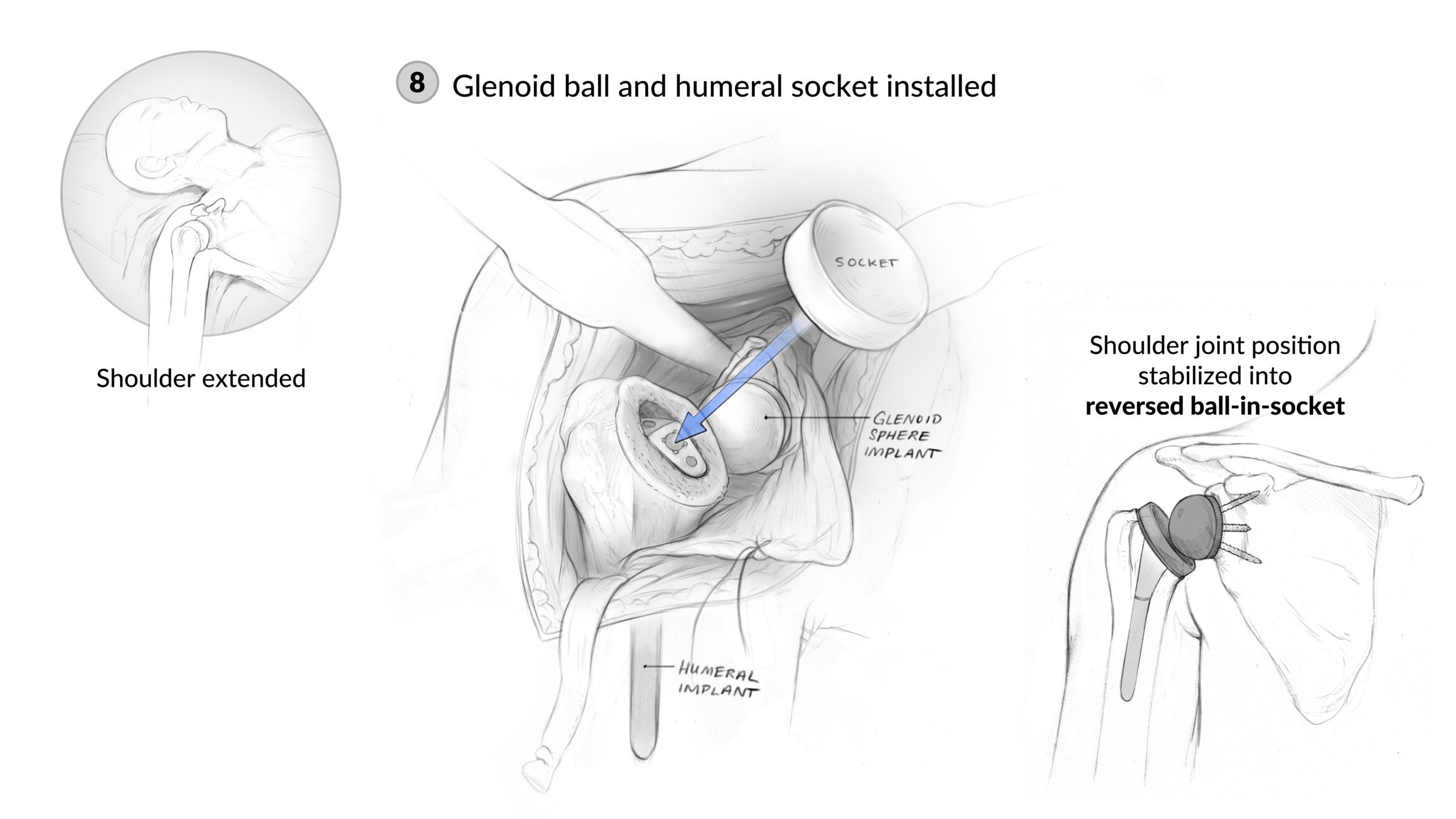 7_Implants