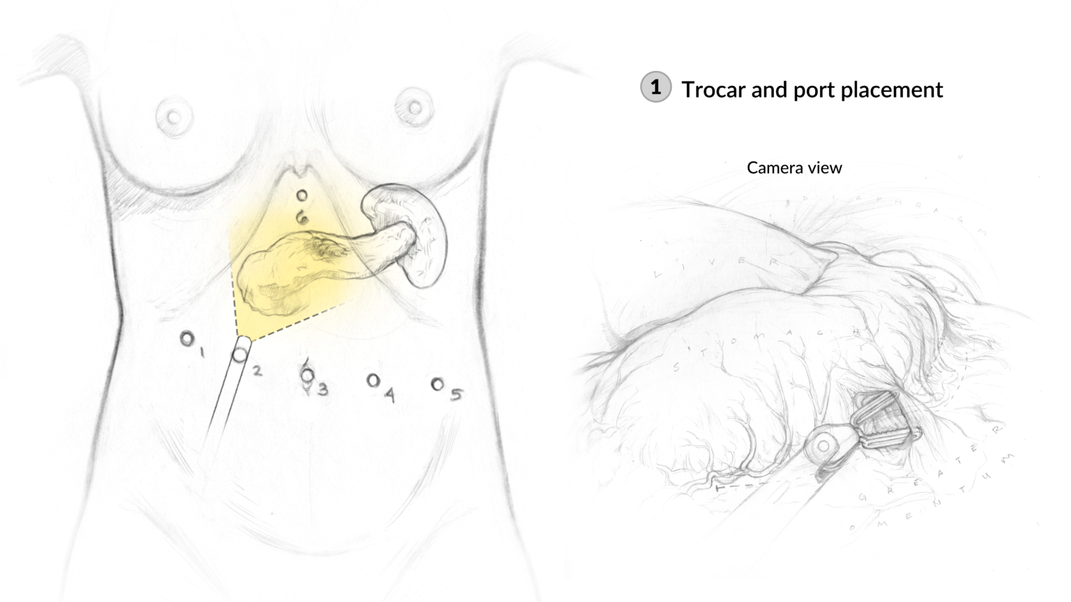 Surgical sketches