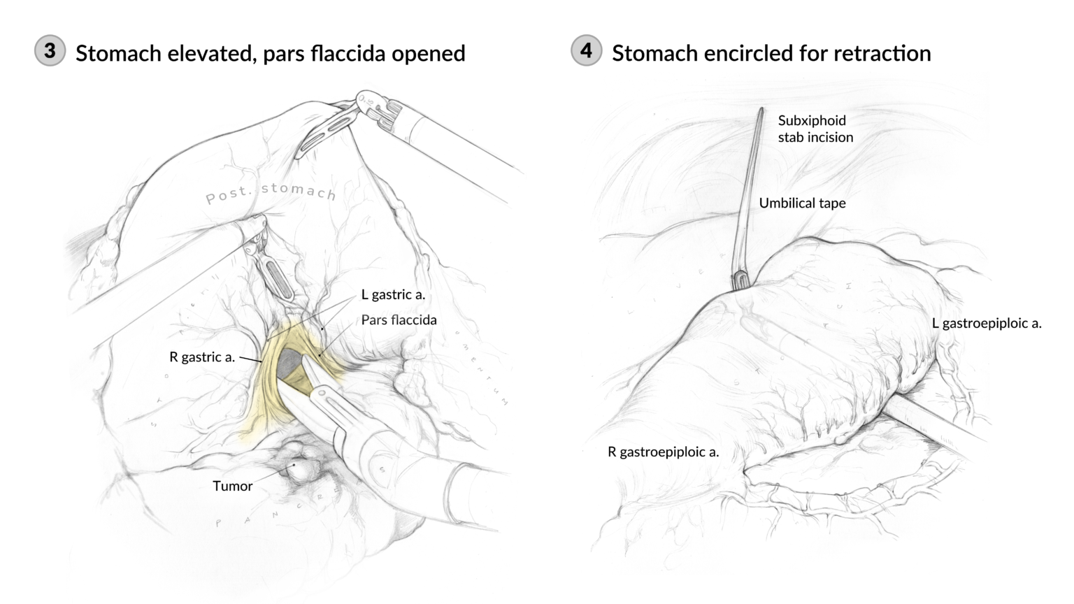 Surgical sketches