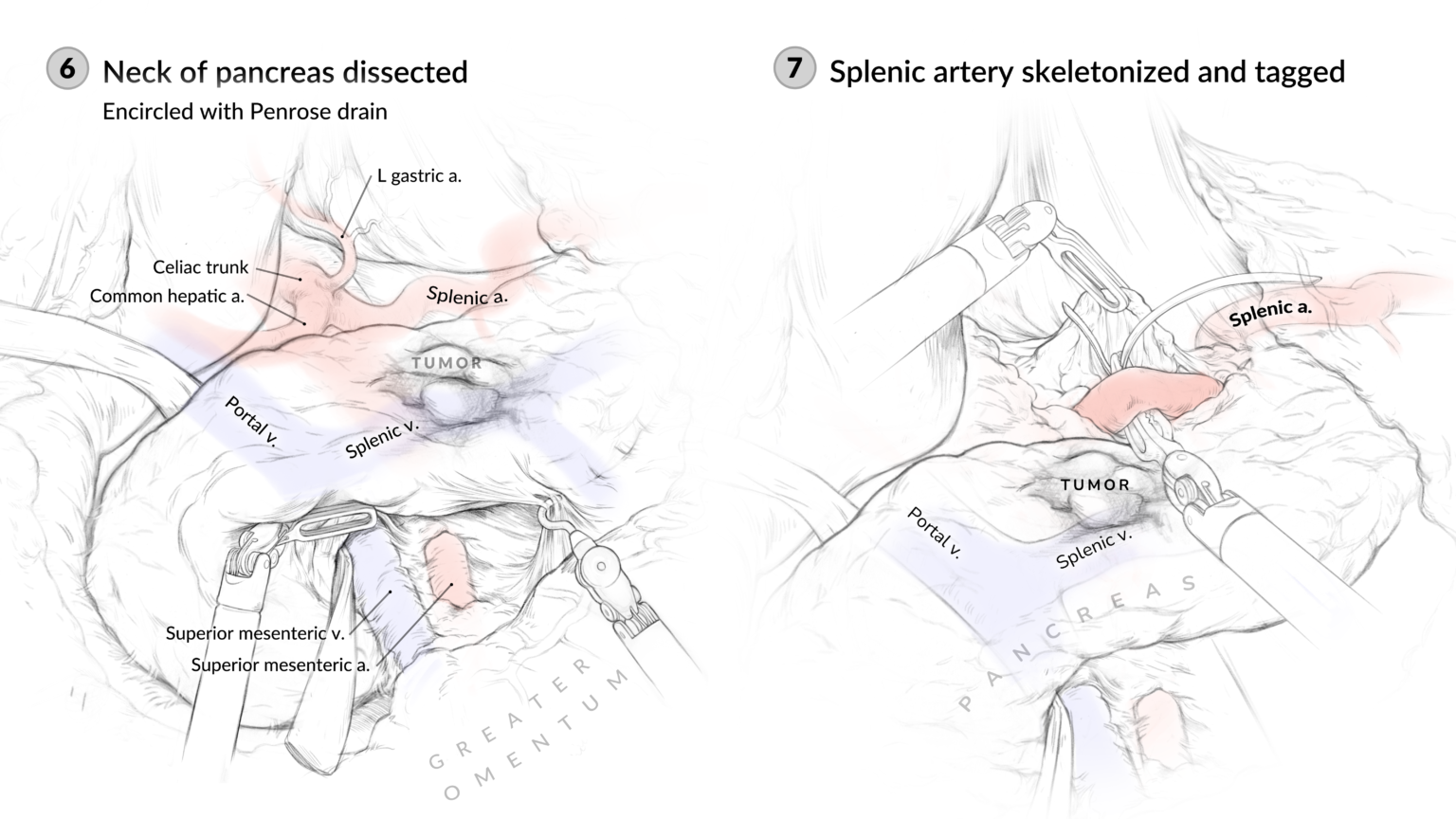 Surgical sketches